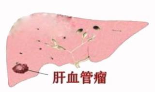 治血管瘤要多少钱